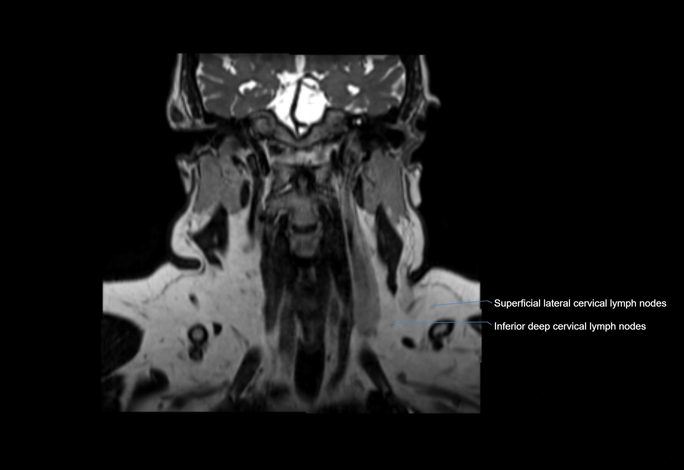 Neck coronal lymph node cross sectional MRI anatomy 3T MRI  image-img-00001-00034.webp